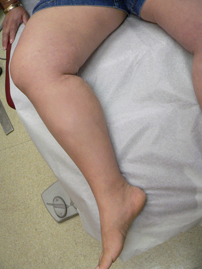 Combination of Leg Vein Treatments