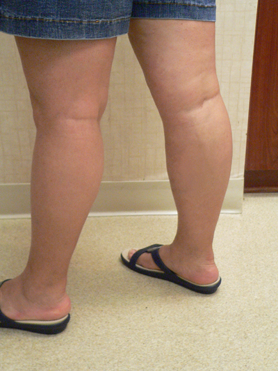 Combination of Leg Vein Treatments