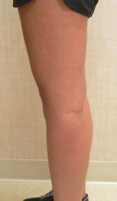 Combination of Leg Vein Treatments