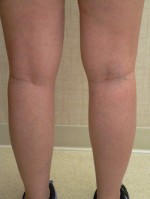 Combination of Leg Vein Treatments