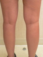 Combination of Leg Vein Treatments