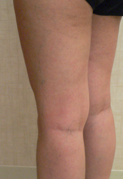 Combination of Leg Vein Treatments