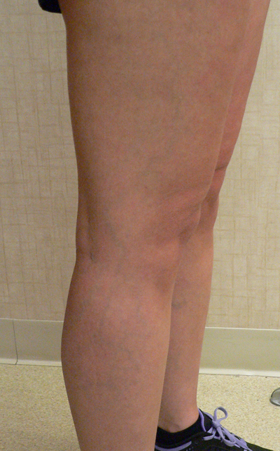 Combination of Leg Vein Treatments