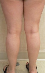 Combination of Leg Vein Treatments