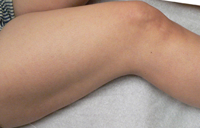 Sclerotherapy Photos