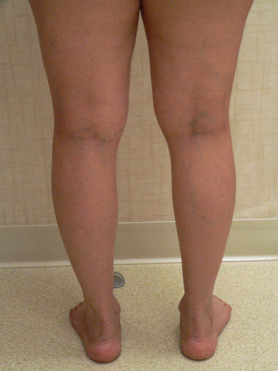 Sclerotherapy Photos