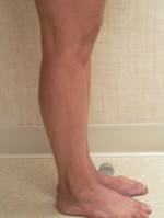 Sclerotherapy Photos