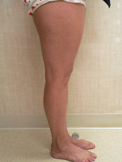 Sclerotherapy Photos