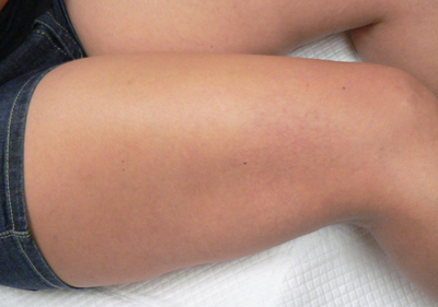 Sclerotherapy Photos