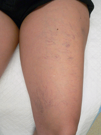 Sclerotherapy Photos