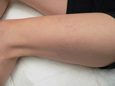 Sclerotherapy Photos