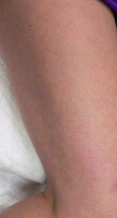 Sclerotherapy Photos