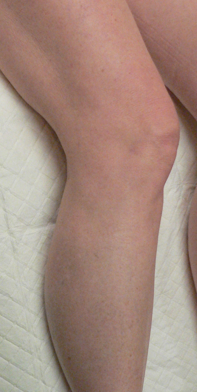 Sclerotherapy Photos