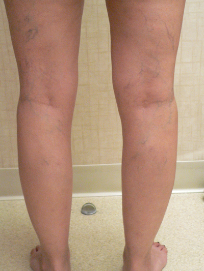 Sclerotherapy Photos