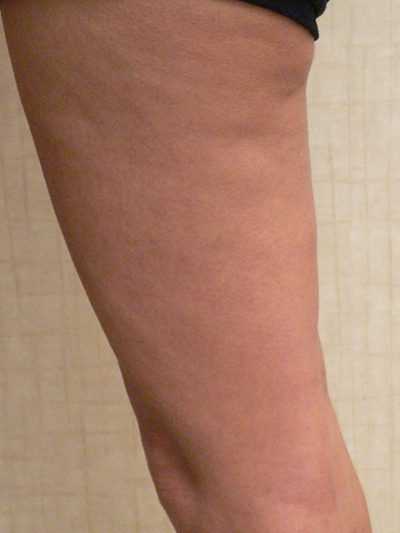 Sclerotherapy Photos