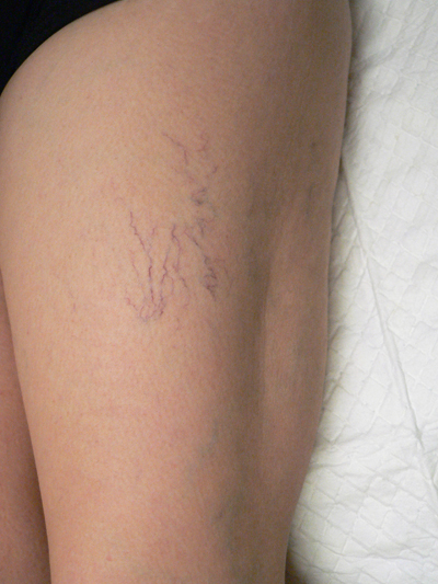 Sclerotherapy Photos