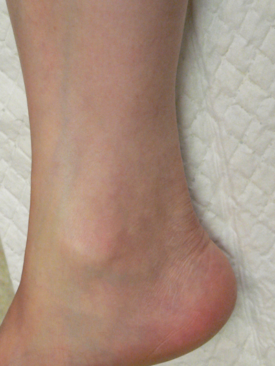 Sclerotherapy Photos