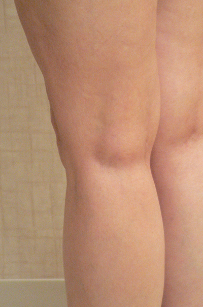 Sclerotherapy Photos