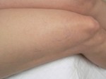 Sclerotherapy Photos