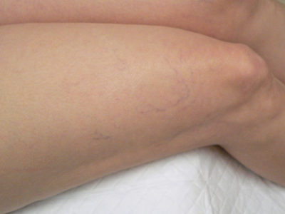 Sclerotherapy Photos