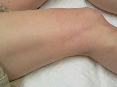 Sclerotherapy Photos