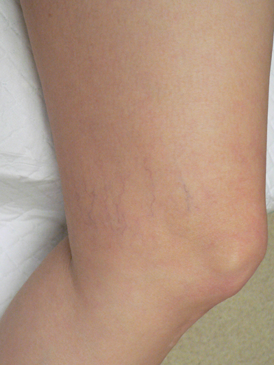 Sclerotherapy Photos