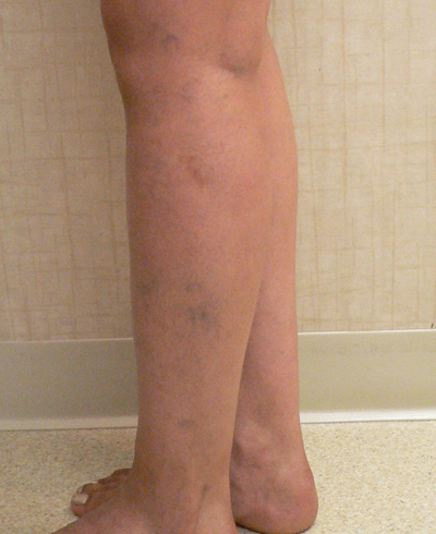 Sclerotherapy Photos