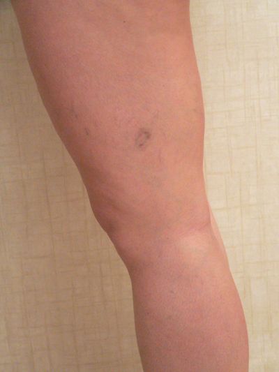 Sclerotherapy Photos