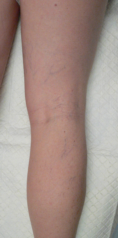 Sclerotherapy Photos