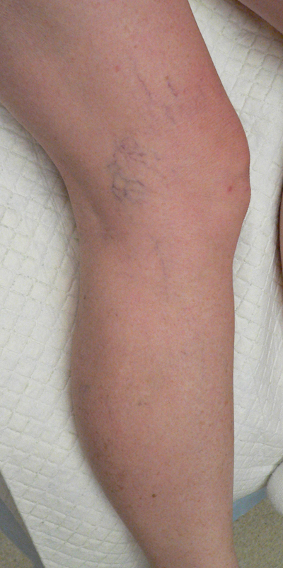 Sclerotherapy Photos