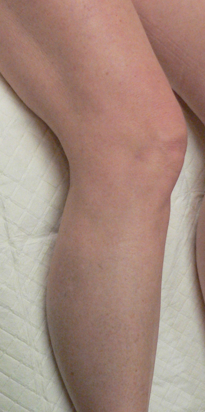 Sclerotherapy Photos