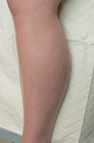 Sclerotherapy Photos