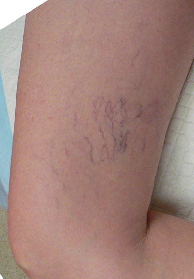 Sclerotherapy Photos