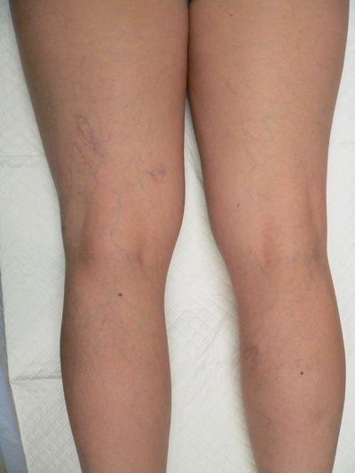 Sclerotherapy Photos