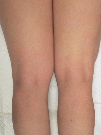 Sclerotherapy Photos