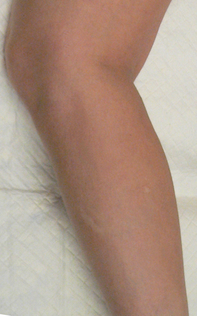 Sclerotherapy Photos