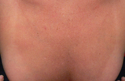 Chest Veins