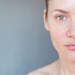 What Is the Best Facial Vein Treatment? 2 Female patient has red vessels on her face