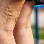 Close-up of legs with visible spider veins and varicose veins, a common condition that can be treated.
