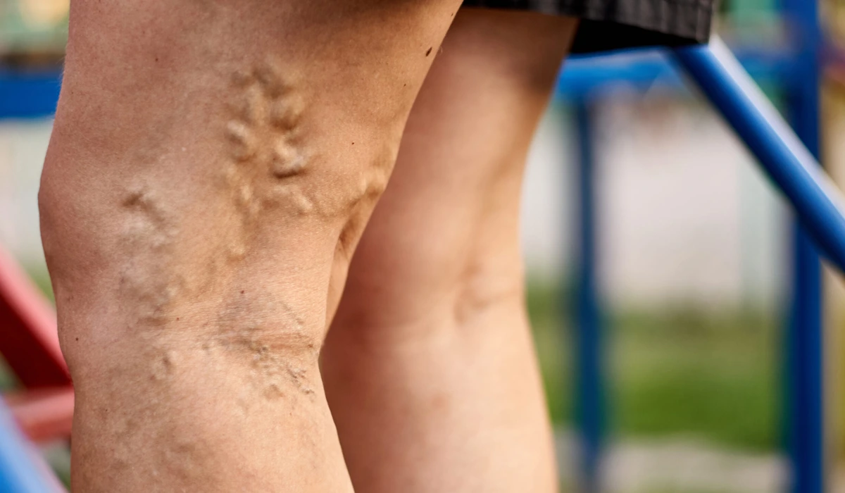 How Long Do Spider Vein Treatment Results Last? 1 Close-up of legs with visible spider veins and varicose veins, a common condition that can be treated.