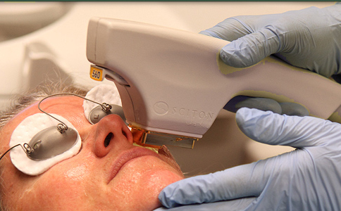 Sciton's BBL system for the removal of fine veins Sciton's BBL Handpiece for Facial Vein Treatment