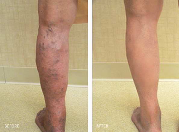 Before and after endovenous laser treatment for varicose veins
