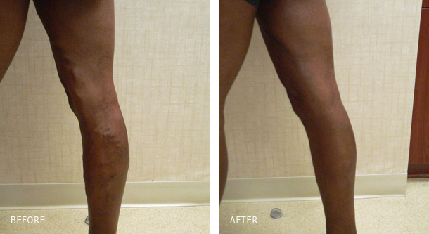 Varicose vein treatment with VENEFIT performed by the vein specialist of Nu Vela in Los Angeles - Before and After Photos border=