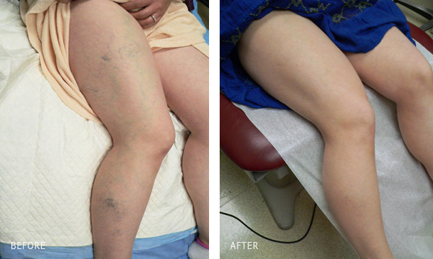Before and after EVLT for varicose vein treatment