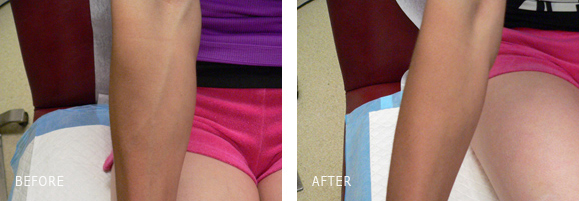 Hand Vein Sclerotherapy Removal - Before and After Photos Hand Vein Sclerotherapy Removal Before and After Los Angeles