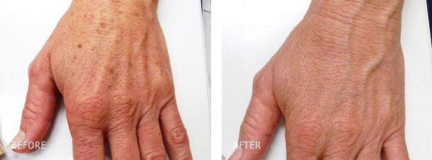Hand Veins 2 LASER REMOVAL OF SUN AND AGE SPOTS ON HANDS BEFORE AND AFTER LOS ANGELES