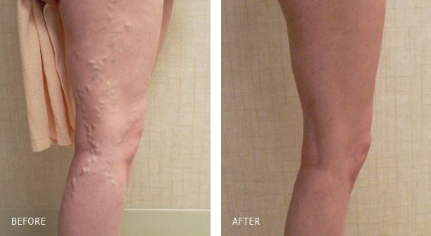 Foot and Leg Vein Treatment 2 FOAM SCLEROTHERAPY FOR BULGING LEG VARICOSE VEIN REMOVAL