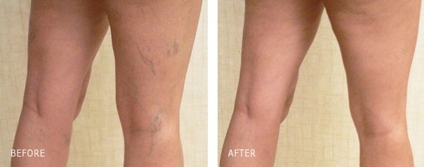 Sclerotherapy Spider Vein