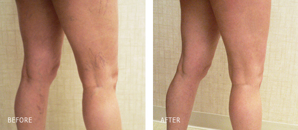 Injection therapy of leg spider veins