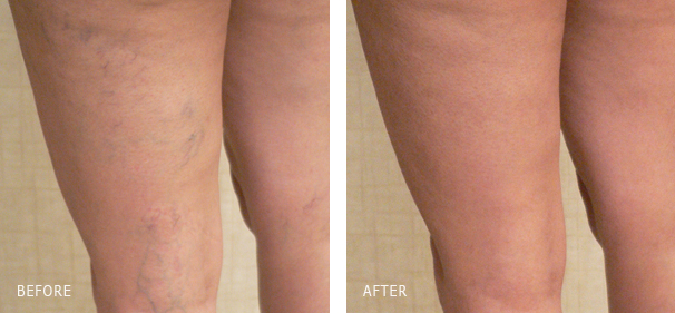 Leg vein treatment result - performed in Los Angeles by Dr. Dishakjian